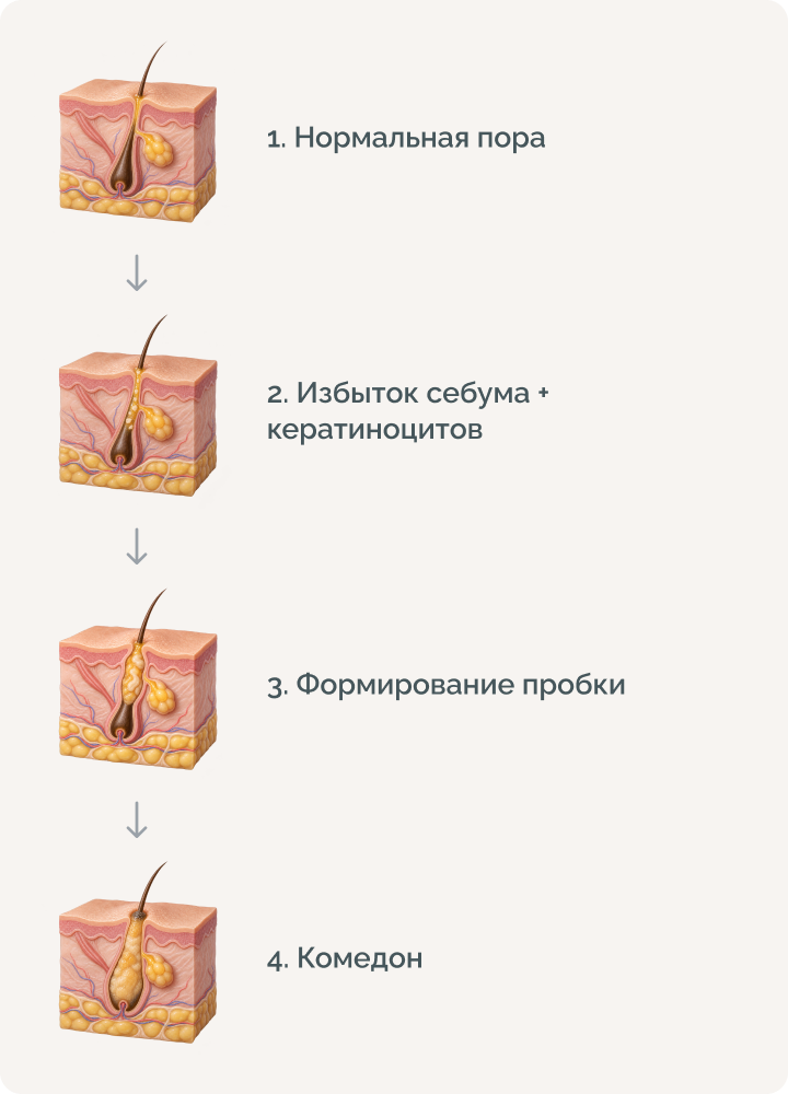 Что такое комедоны и чем они отличаются от других высыпаний